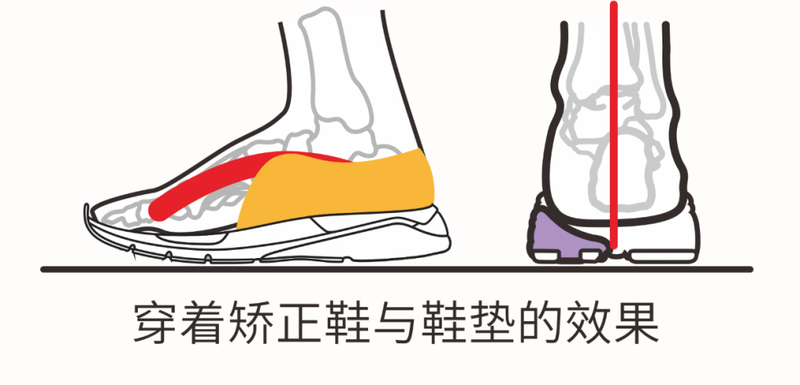 新学期新起点：矫正鞋助力孩子自信前行_新闻热点
