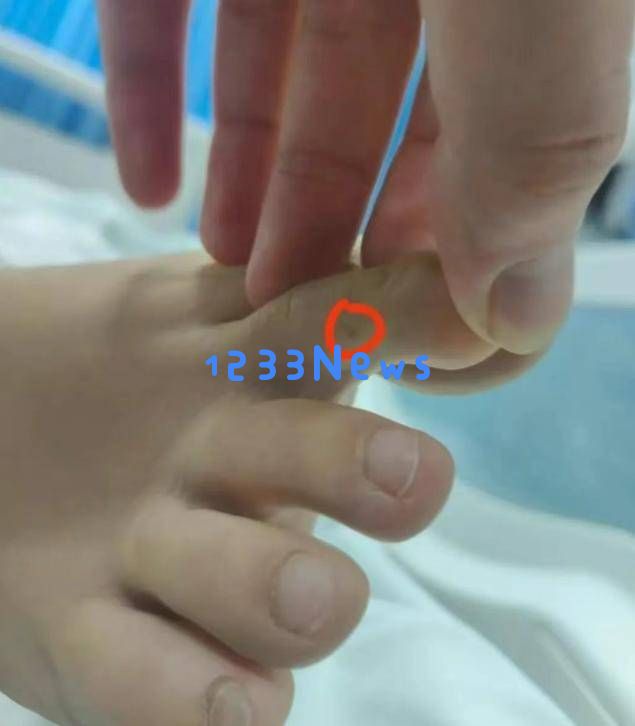 三亚女游客因毒蛇或毒虫咬伤身亡，卫健委介入调查是否存在治疗延误