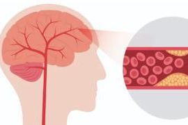 打破高血压的神秘面纱：大脑缺氧或为病因 荷蓬茶源素提供新的降压方案