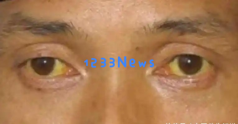 早晨如果出现这三种异常信号，可能是肝脏正在发出求救信号，务必引起重视！